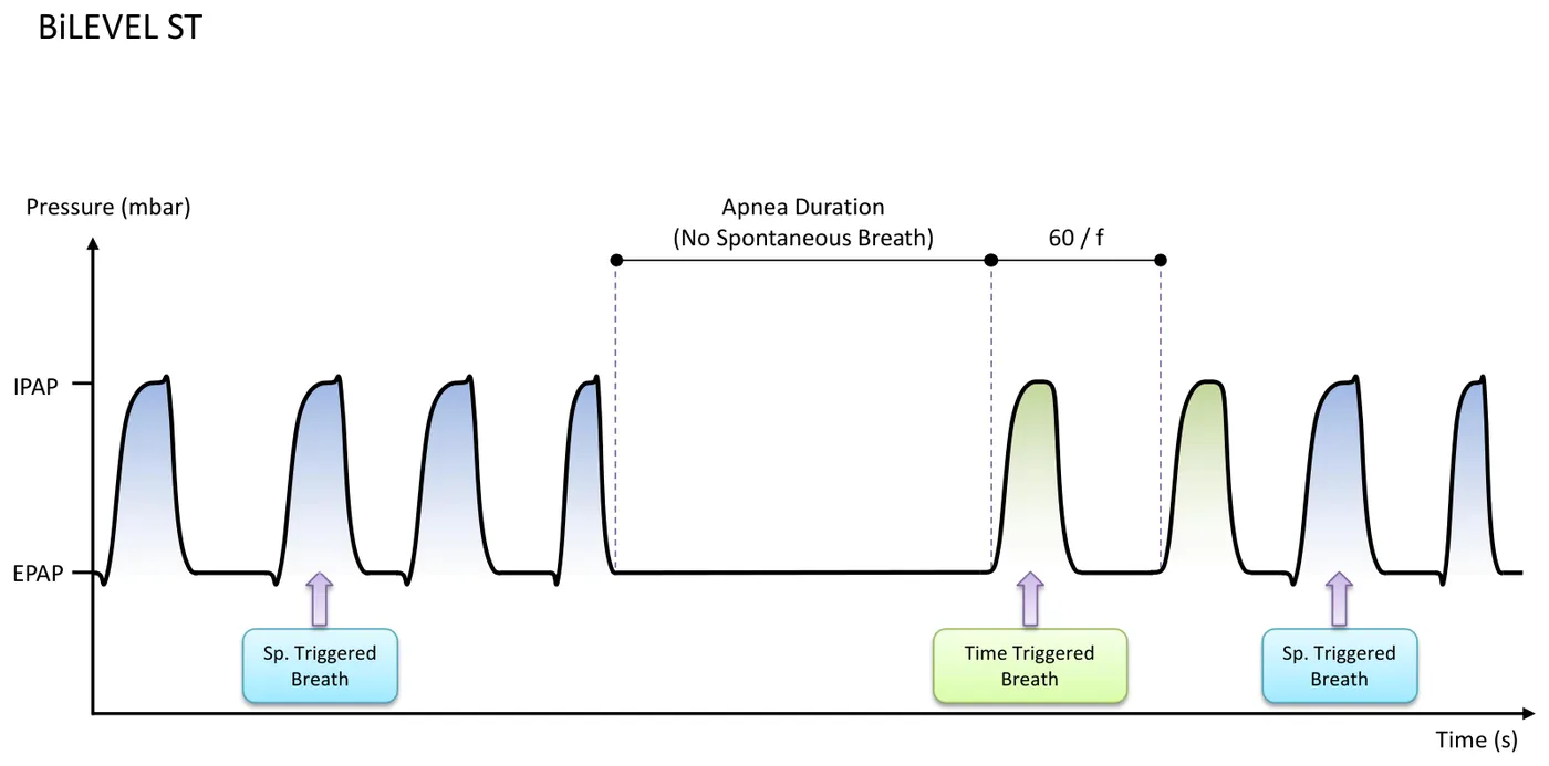 BiLEVEL ST Waveform