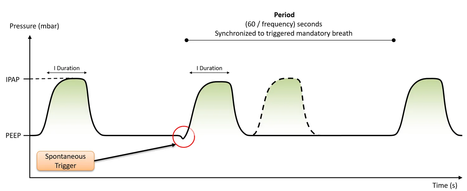 PCV-A waveform