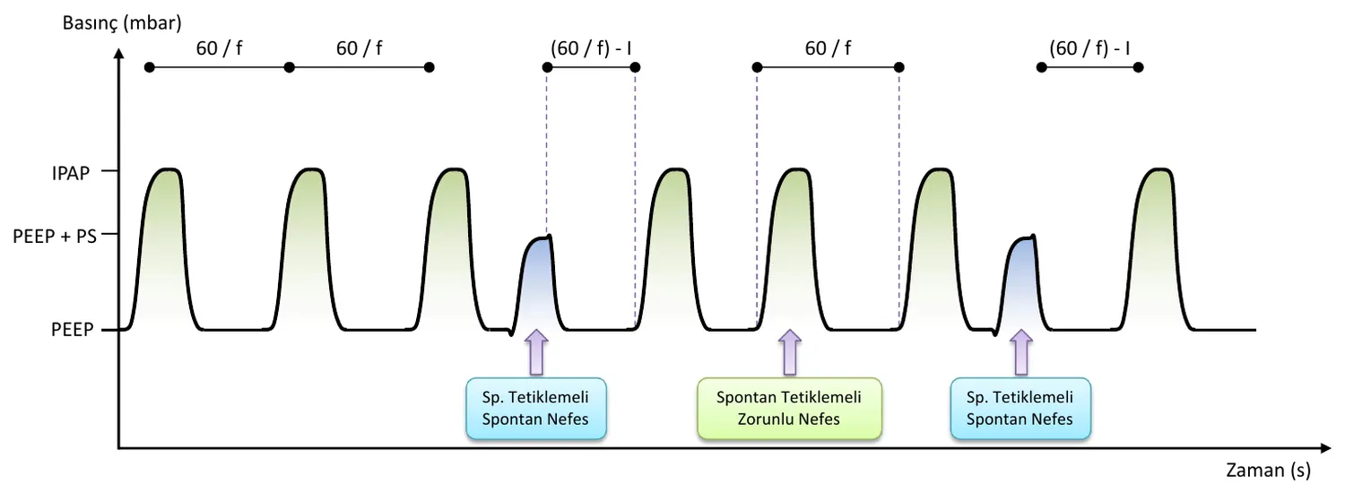 SIMV-P waveform